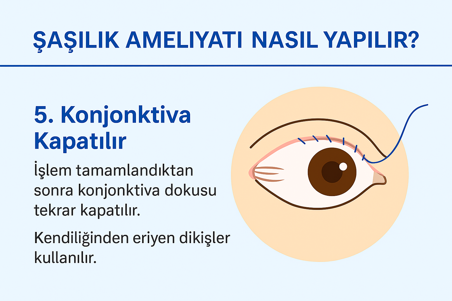 Konjonktiva dokusunun tekrar kapatıldığı cerrahi aşamayı gösteren diyagram