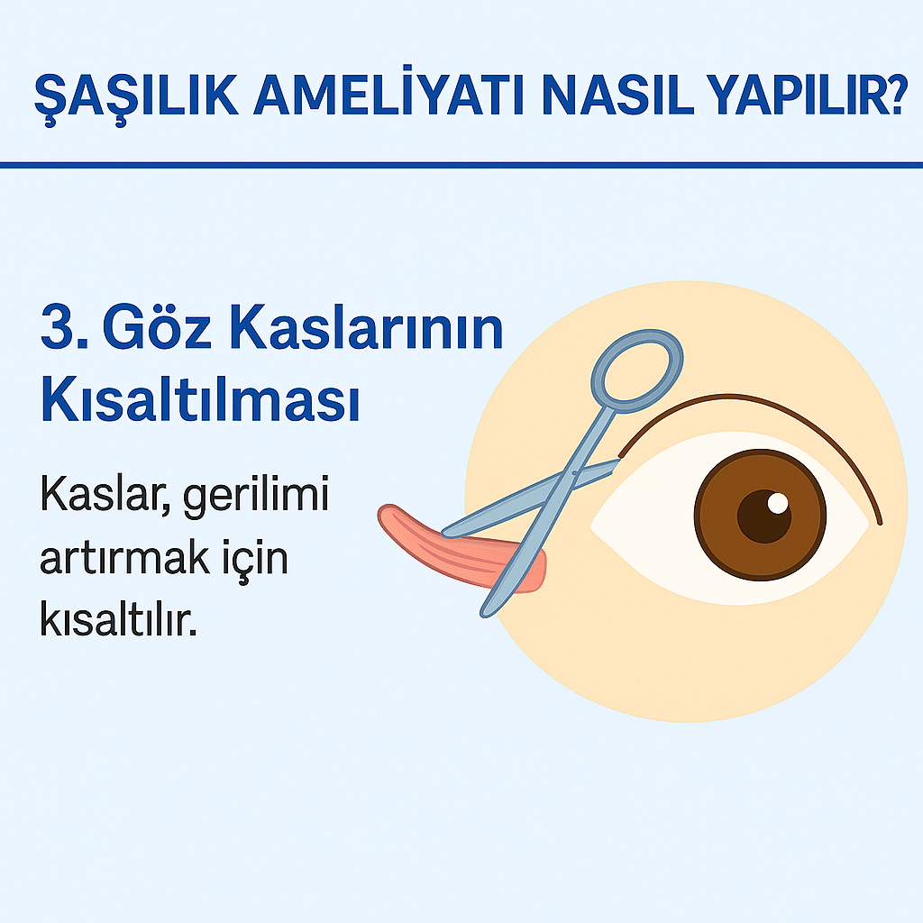 Göz hizalamasını düzeltmek için kasların yeniden konumlandırıldığı adımı gösteren grafik