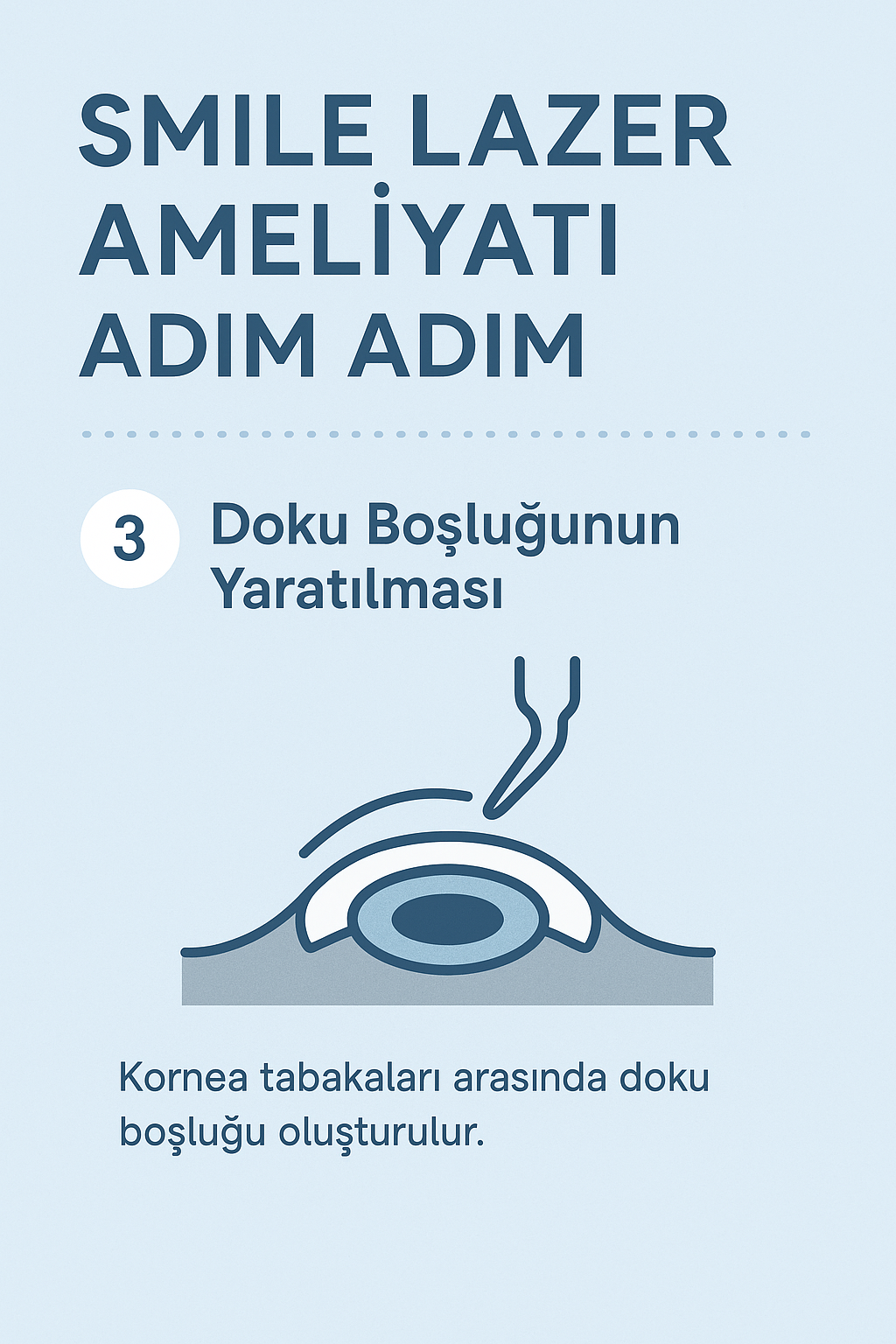 Kornea içinde lentikülün çıkarılacağı mikro boşluğun oluşturulması