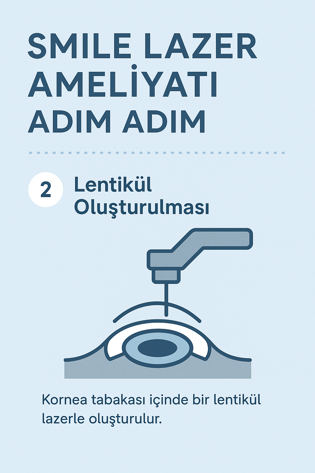 Kornea içinde lazerle lentikül kesimi yapılması