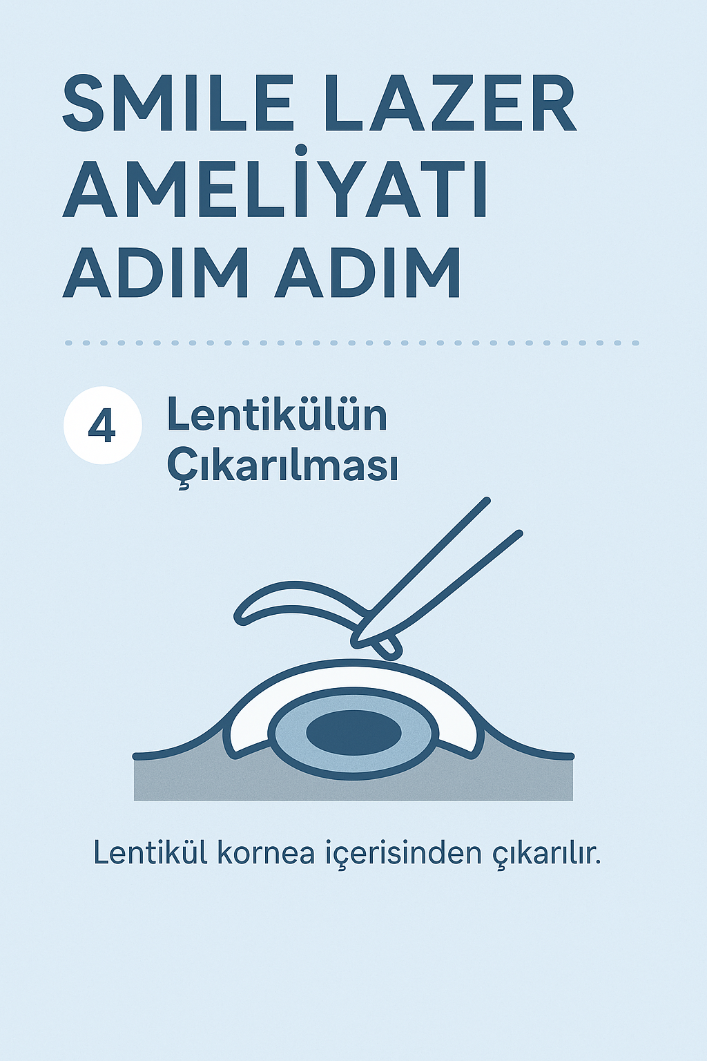 Cımbız benzeri aletle korneadaki lentikülün çıkarılması